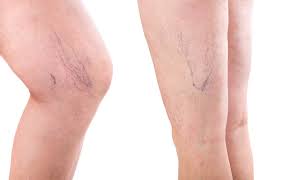 Things To Expect From The Treatment of Your Spider Veins